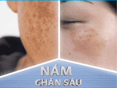 TRỊ NÁM CHÂN SÂU
