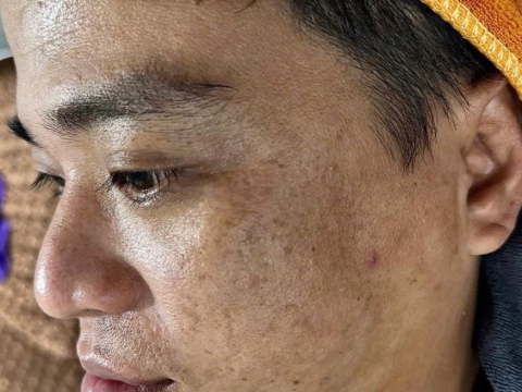 Dịch vụ điều trị nám