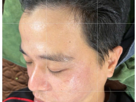 Dịch vụ điều trị nám