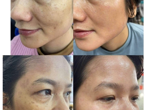 Dịch vụ điều trị nám